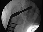 Right hip dynamic compression screw