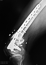 Right femur periarticular plate breakage