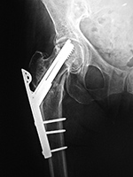 Fixation screw projecting into right hip joint
