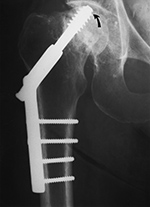 Screw in right hip joint
