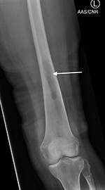 Bone graft harvesting postoperative image