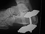 Calcaneal traction