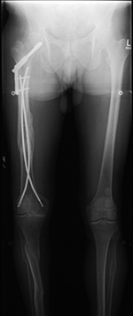 Enders rods in right femur