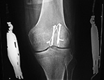 Hinged knee brace AP view