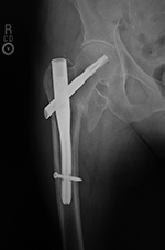 Short hip nail with helical femoral neck screw