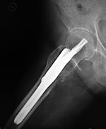 Short hip nail with helical femoral neck screw