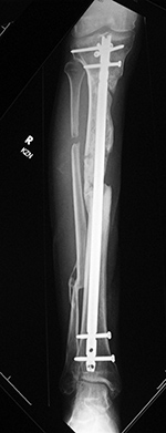 Right tibia dynamization - before
