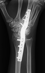Wrist arthrodesis with low contact dynamic compression plate