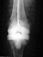 Antiobiotic impregnated cement temporary TKA