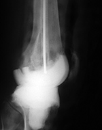 Antibiotic impregnated cement temporary TKA