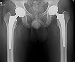 Bilateral total hip arthroplasty