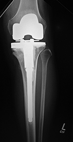 Biomet Vanguard TKA