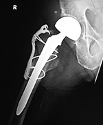 Bipolar hemiarthroplasty with claw plate and cables
