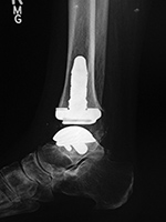 INBONE II total ankle replacement