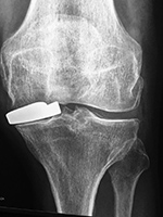 Left knee interpositional arthroplasty