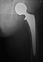 Left hip endoprosthesis
