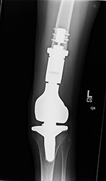 Limb sparing prosthesis