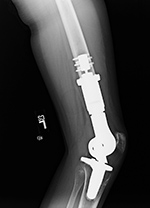 Limb sparing prosthesis lateral view