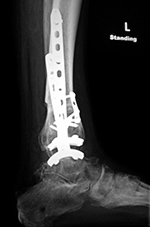 Zimmer trabecular metal total ankle prosthesis