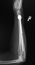 Left forearm reconstruction