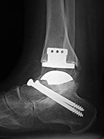 Total ankle arthroplasty