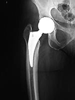 Metal-on-metal right hip implant