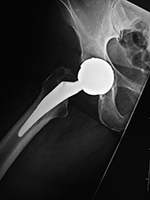 Metal-on-metal hip implant