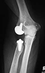 Left elbow radiocapitellar arthroplasty