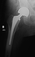 Right hip stress shielding before image