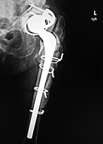 Triflange acetabular revision hip arthroplasty