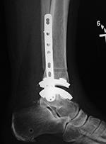 Total ankle prosthesis