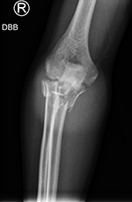 Comminuted elbow fractures frontal view