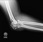 Comminuted elbow fractures lateral view