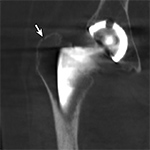 Periprosthetic fracture